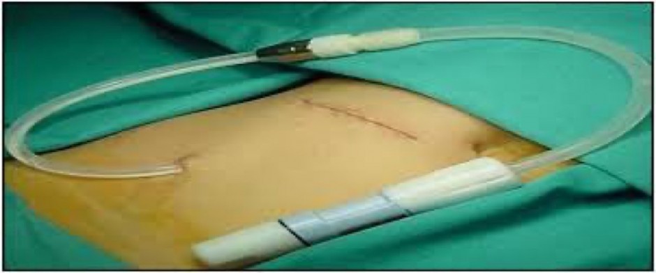 Actualizaci&oacute;n en di&aacute;lisis peritoneal